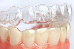 Aparelho dental Invisalign em Irecê Aparelho dental Invisalign em Irecê