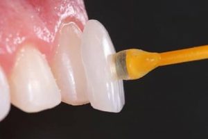 Lente Dental em Irecê Lente Dental em Irecê